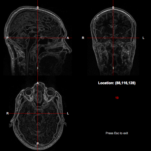 Morphological gradient of brain image