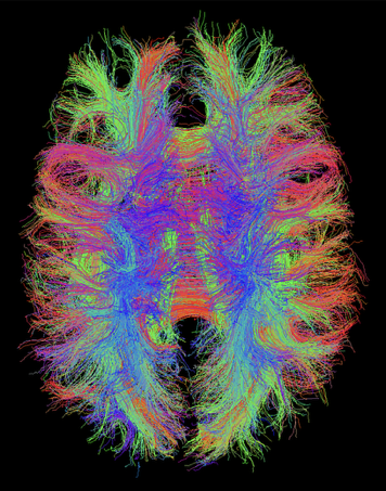 TrackVis visualisation of streamlines